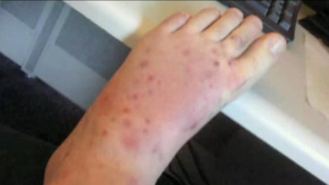 19 black widow spider bites